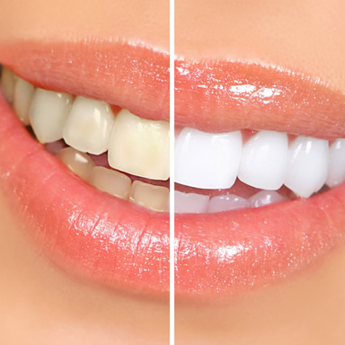 Clareamento Dental